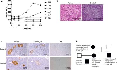 Case Report: Hypoglycemia Due to a Novel Activating Glucokinase Variant in an Adult – a Molecular Approach